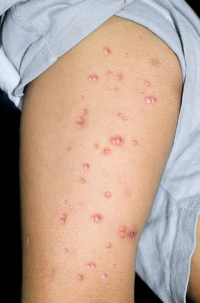 Monkeypox lesions in the thigh of Asian, Burmese Child. Monkeypox lesions in the thigh of Asian, Burmese Child